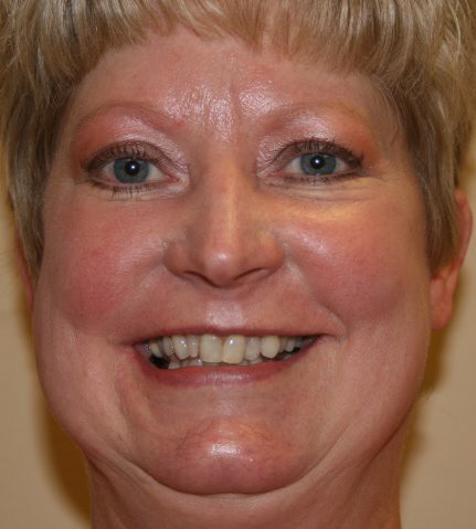 Cosmetic Before Image--Female